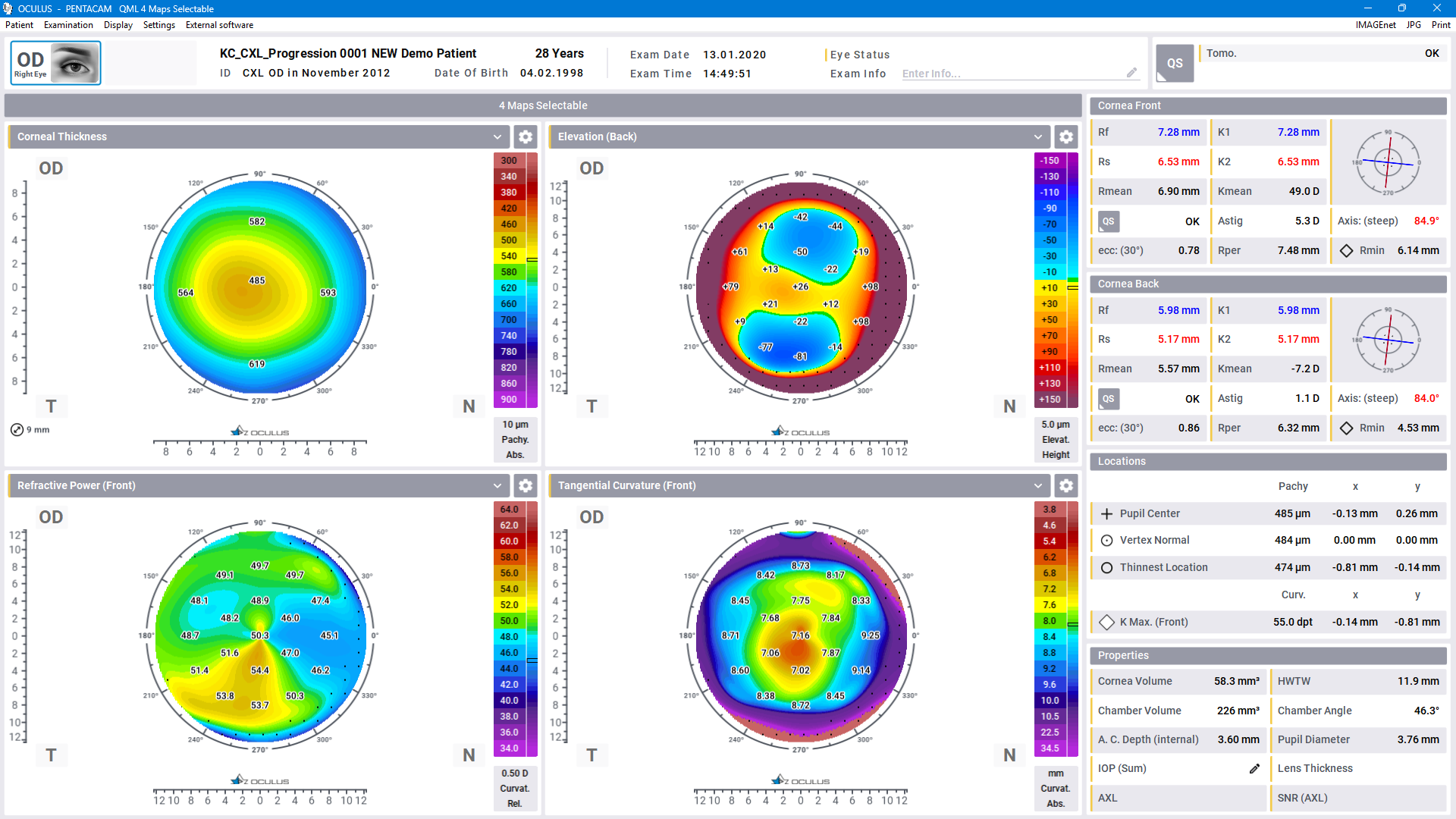 Pentacam® Software - 4 Maps Selectable