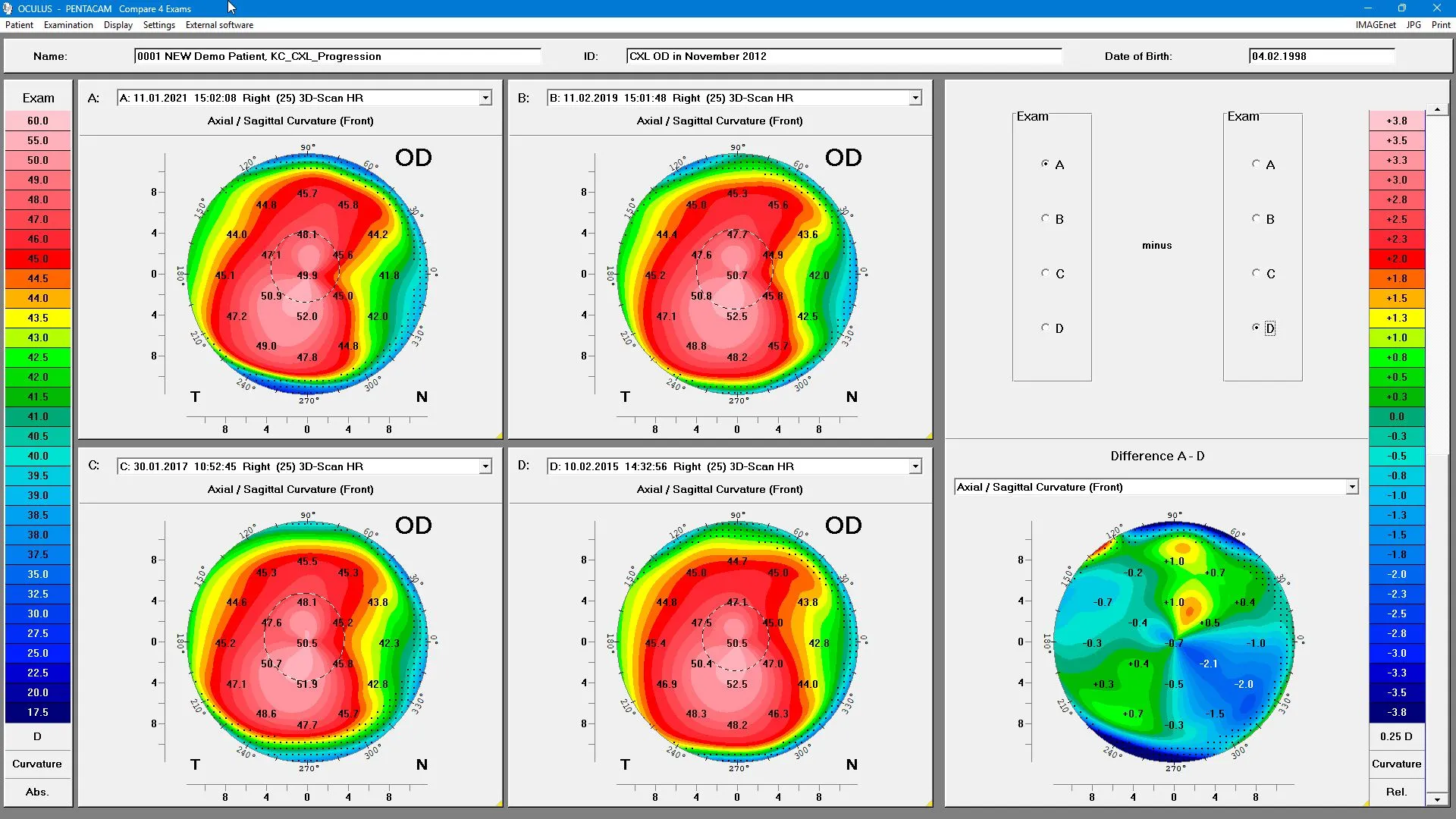 Pentacam® Software - Compare 4 Exams