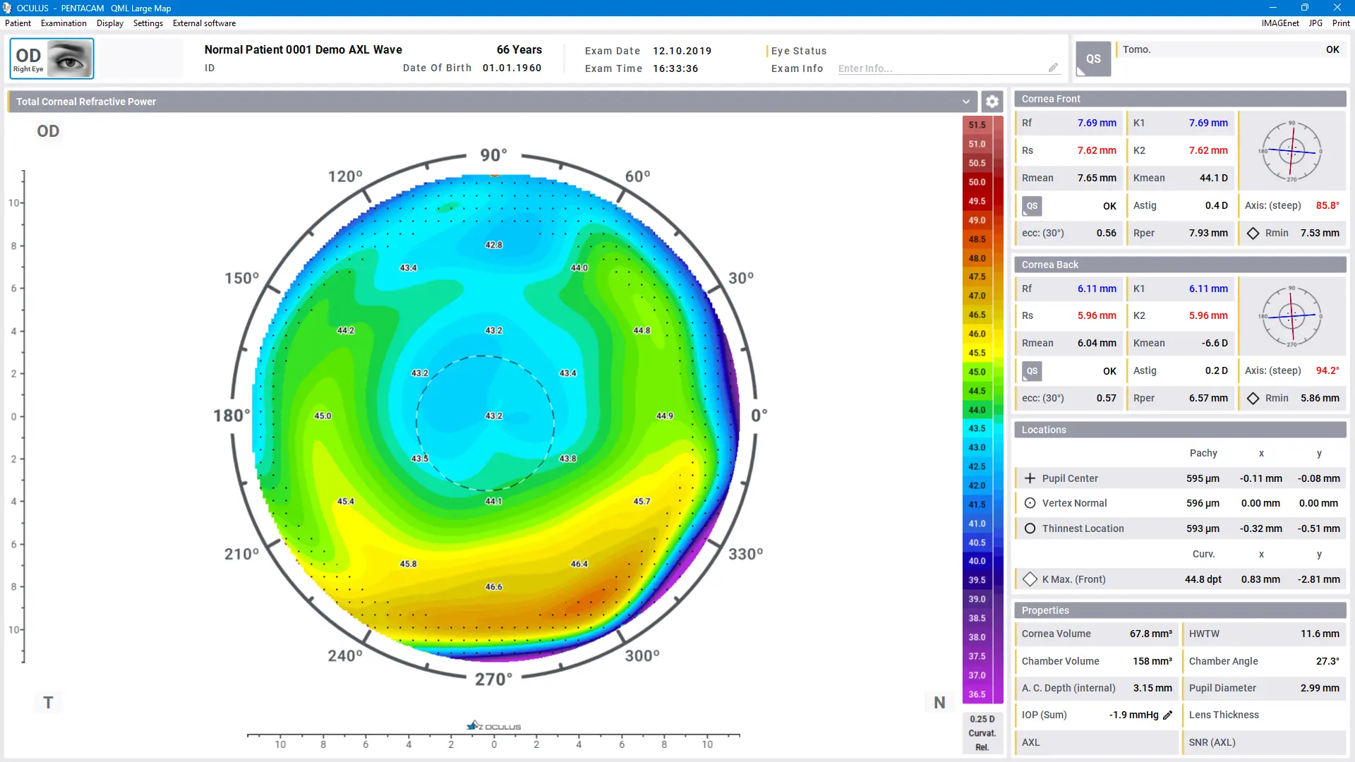 Pentacam® Software - Total Corneal Refractive Power (TCRP)