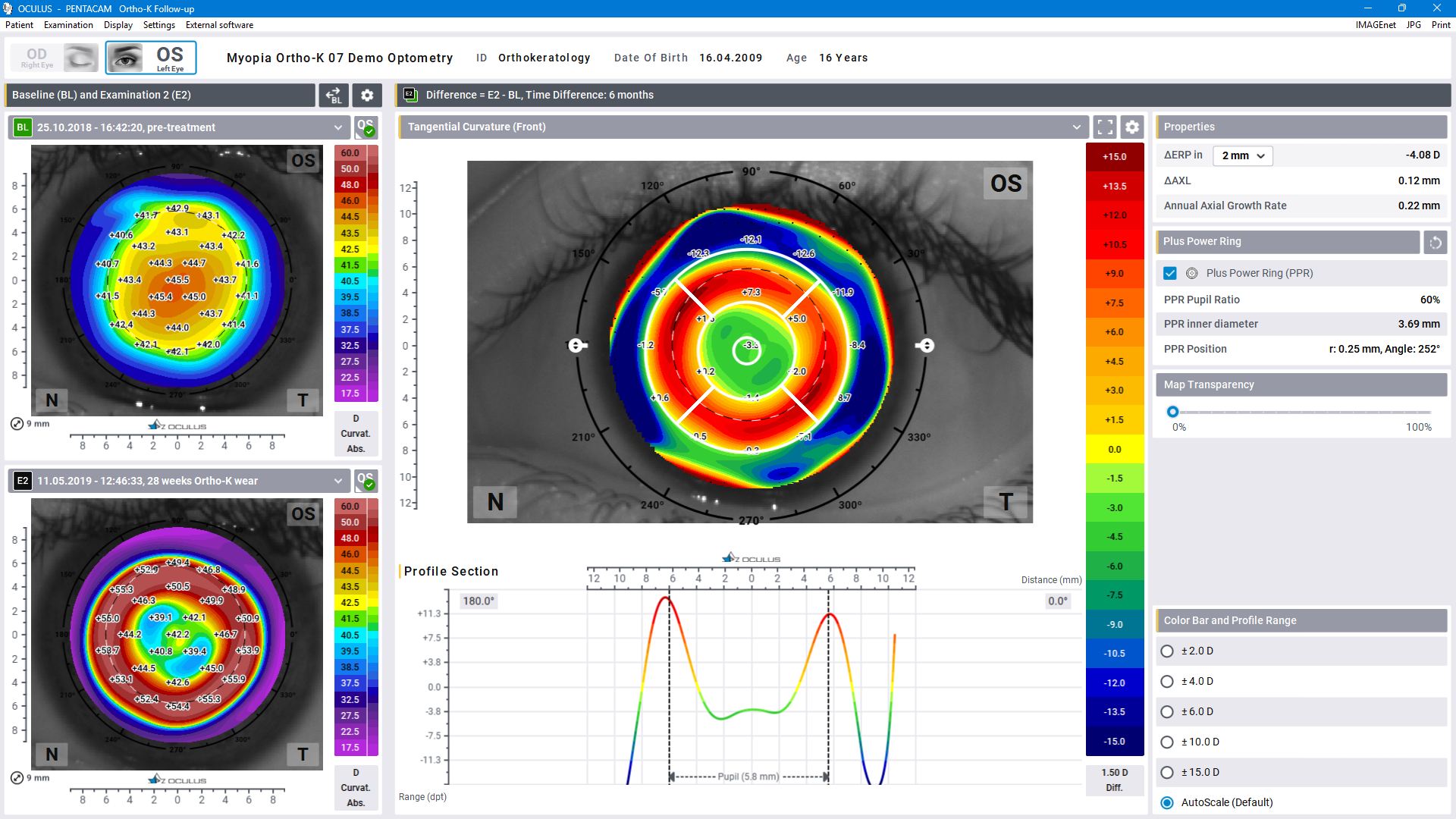 oculus_pentacam_orthok_display_en Ortho-K Follow Up Display from Pentacam