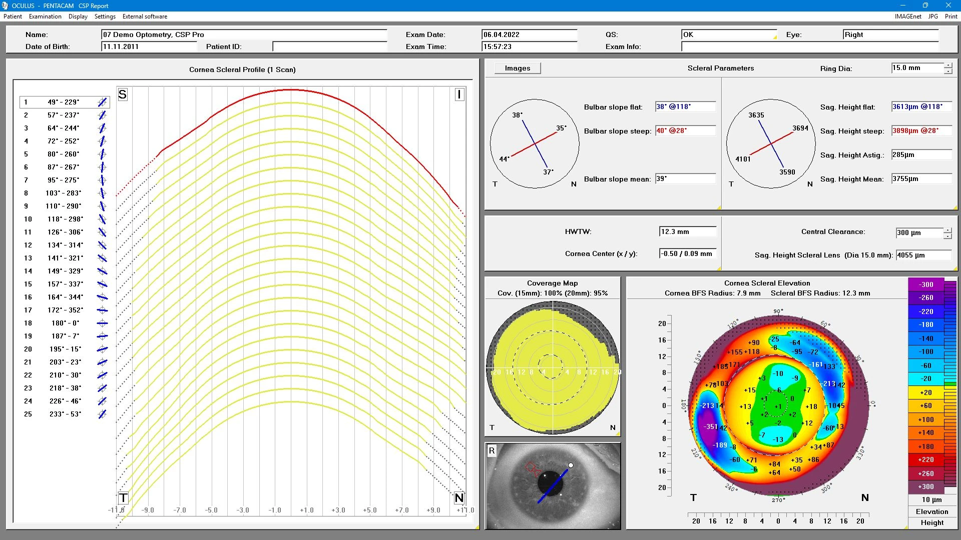 Contact Lens Fitting – Scleral lenses: CSP Report Pro: Measurement up to a sagittal height of 22 mm for scleral lens fitting. Contact Lens Fitting – Scleral lenses: CSP Report Pro: Measurement up to a sagittal height of 22 mm for scleral lens fitting.