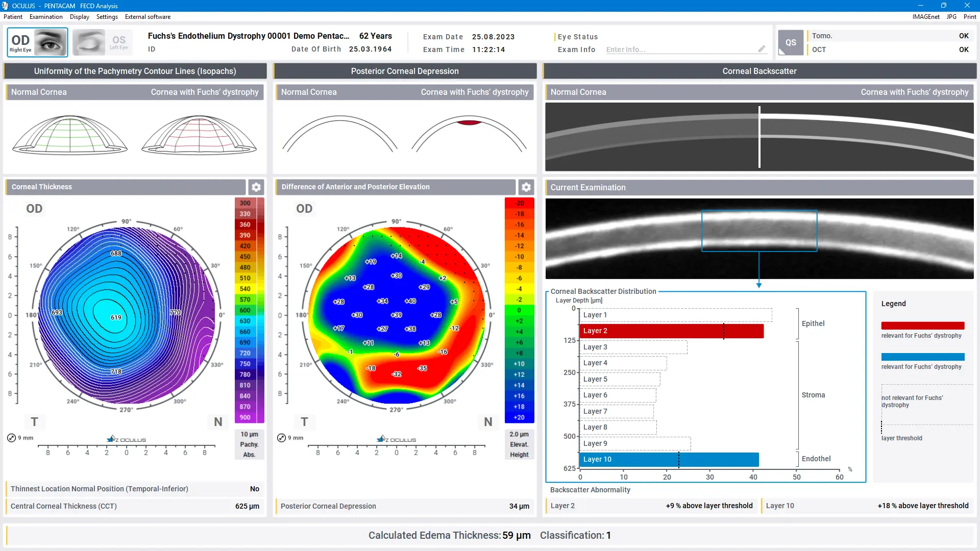 Pentacam® Software - FECD Analysis