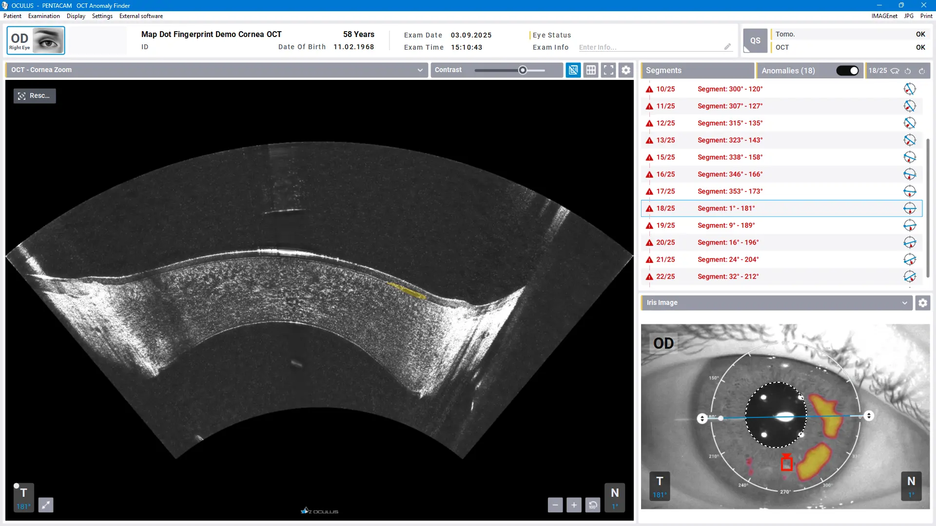 Pentacam® Software - AI Anomaly Finder