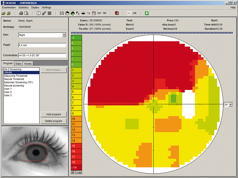 Screenshot der OCULUS Centerfield® 2 Software zur SPARK-Untersuchungsstrategie