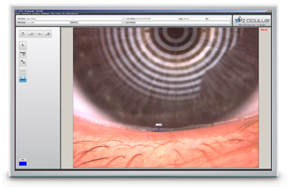 oculus k5m screenshot tfscan lipidschicht 01