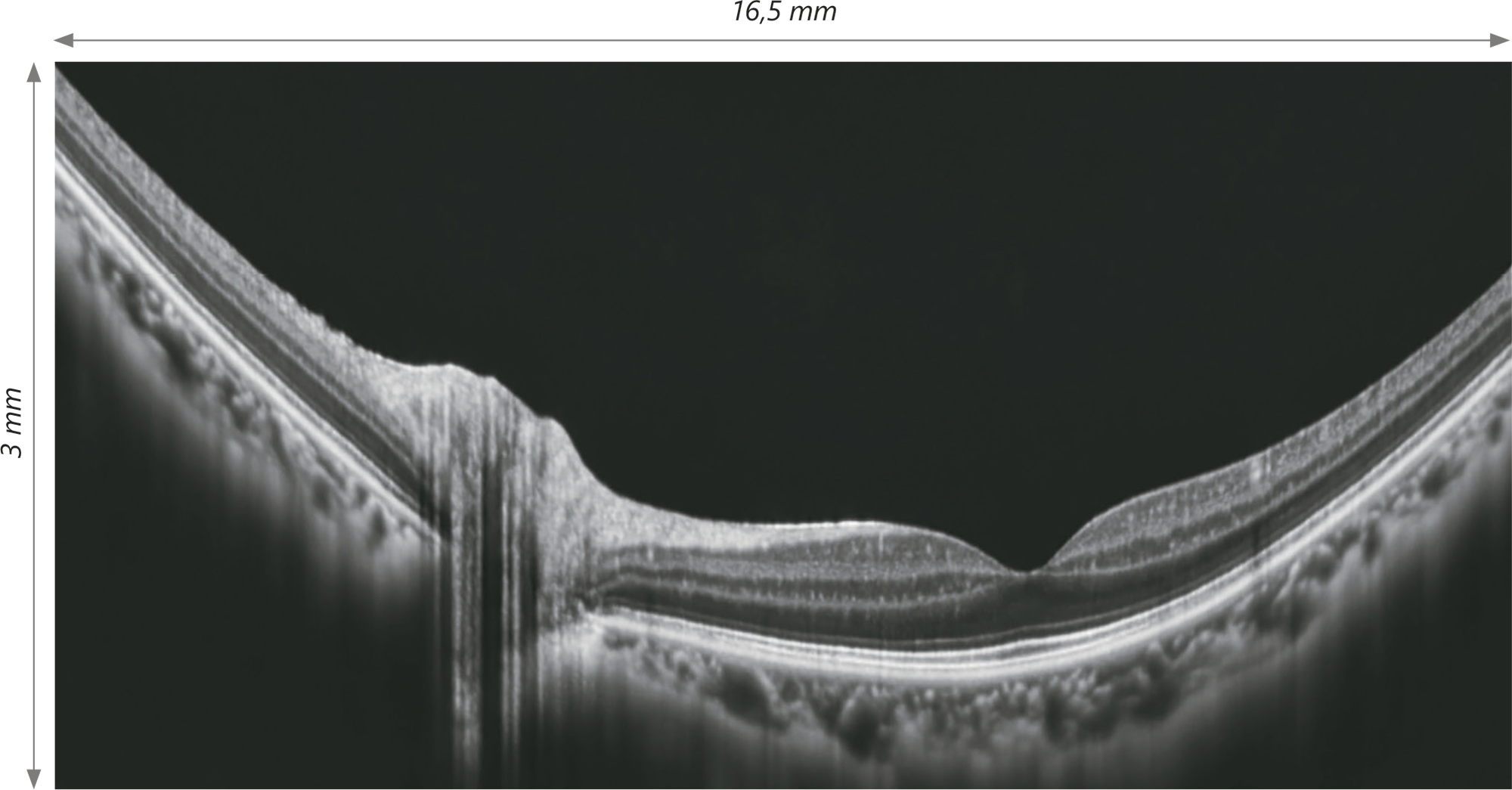OCULUS / NIDEK RSD-1 Duo™